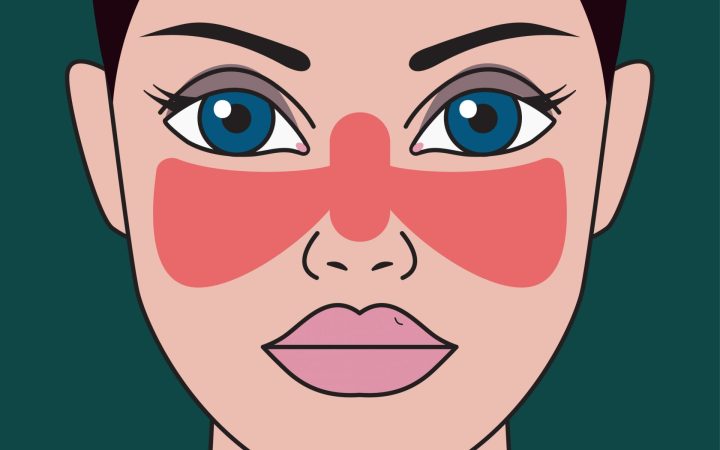 Lupus simptome: erupția în fluture la nivelul feței una dintre manifestările acestei boli