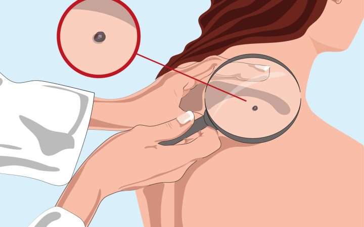Autoexaminarea trebuie să se facă lunar, iar orice modificare suspectă la nivelul pielii trebuie semnalată specialistului.