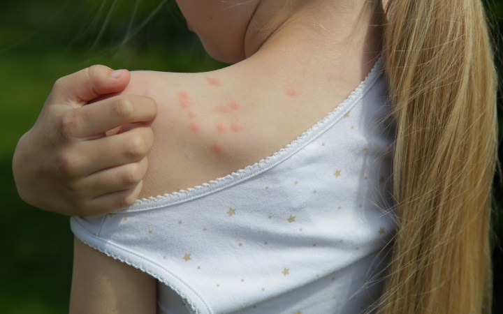 fetiță cu pișcături de insecte pe umăr, care se scarpină