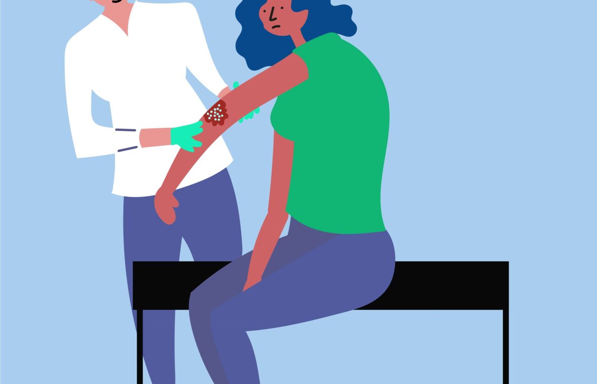 În psoriazis, pielea îngroșată și albă apare cu precădere pe coate, genunchi și scalp Foto: Shutterstock