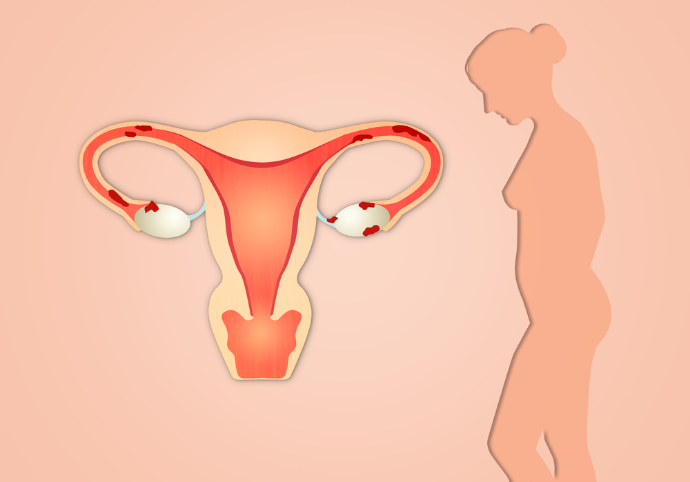ce este endometrioza. aparatul reproducător feminin