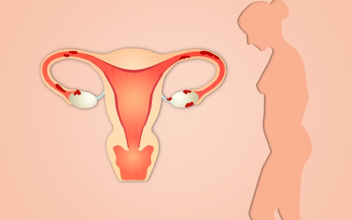 ce este endometrioza. aparatul reproducător feminin