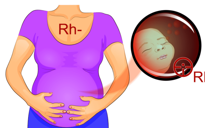 Complicațiile unei incompatibilități Rh între mamă și făt pot apărea în ultimul trimestru de sarcină, la naștere sau imediat după naștere