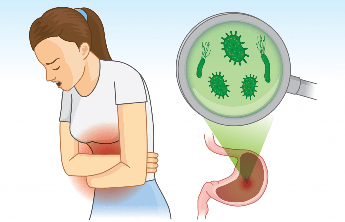 Răceala intestinelor este termenul popular, nemedical pentru diagnosticul de gastroenterită acută.