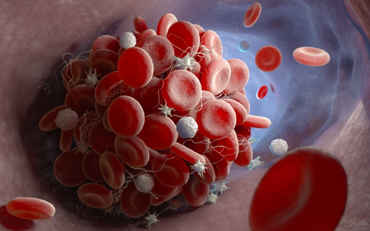 tromboza de vaccinurile COVID-19