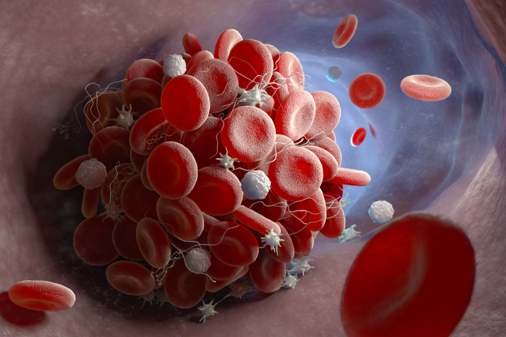 tromboza de vaccinurile COVID-19