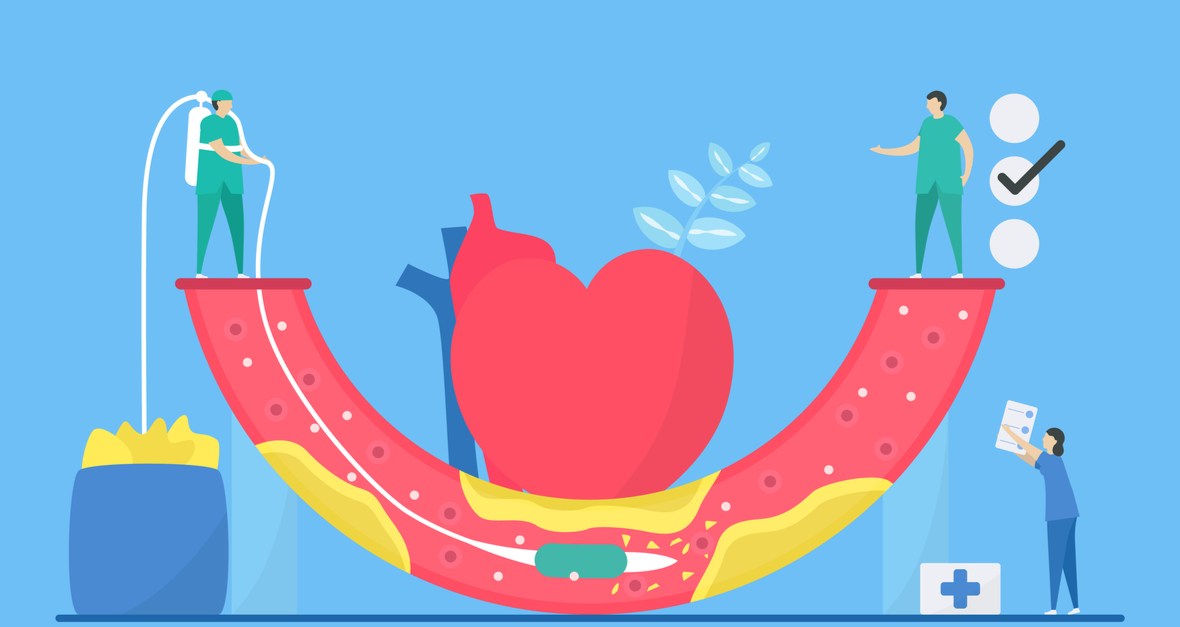 angioplastie ce este si cum se realizeaza. Inima si vas de sange in care medicul a introdus un stent cu balon