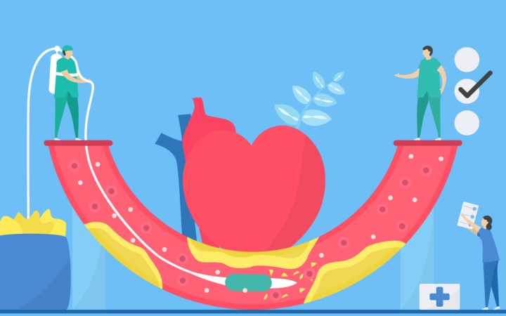 angioplastie ce este si cum se realizeaza. Inima si vas de sange in care medicul a introdus un stent cu balon