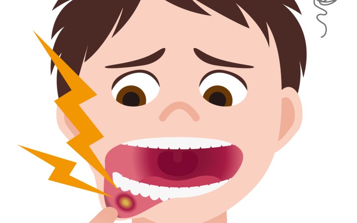 Puteți preveni reapariția aftelor, evitând alimentele care ar fi putut declanșa anterior focarul. Acestea includ adesea alimente picante, sărate sau acide. De asemenea, evitați alimentele care cauzează simptome alergice.
