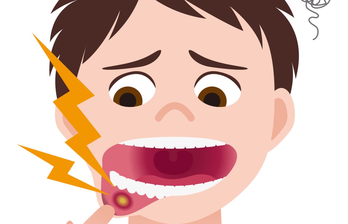 Puteți preveni reapariția aftelor, evitând alimentele care ar fi putut declanșa anterior focarul. Acestea includ adesea alimente picante, sărate sau acide. De asemenea, evitați alimentele care cauzează simptome alergice.