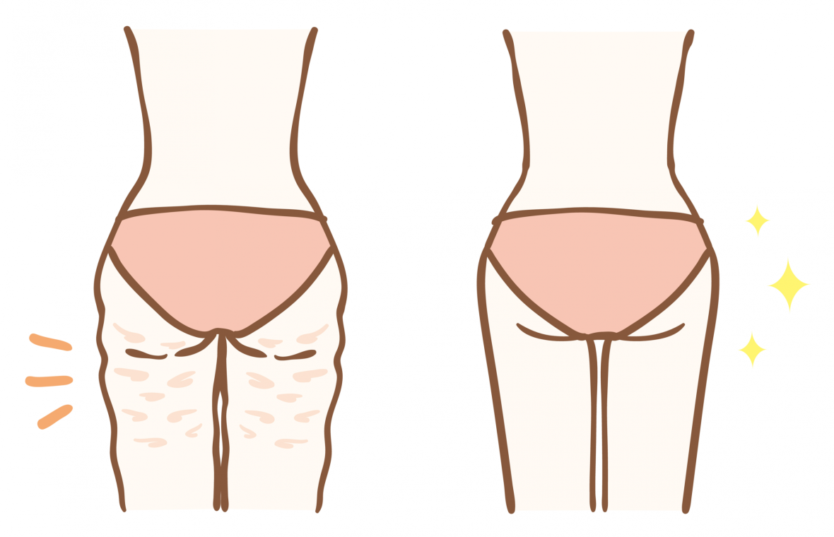 Celulita este un exces de țesut adipos subcutanat care apare în special la nivelul coapselor, șoldurilor, feselor, uneori al abdomenului.