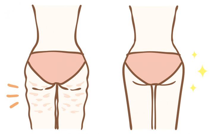 Celulita este un exces de țesut adipos subcutanat care apare în special la nivelul coapselor, șoldurilor, feselor, uneori al abdomenului.