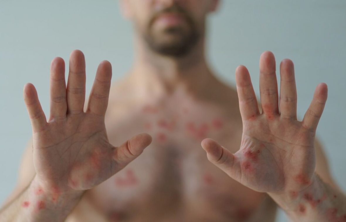 bărbat cu iritații ale pielii cauzate cauzate de variola maimuței (mpox)