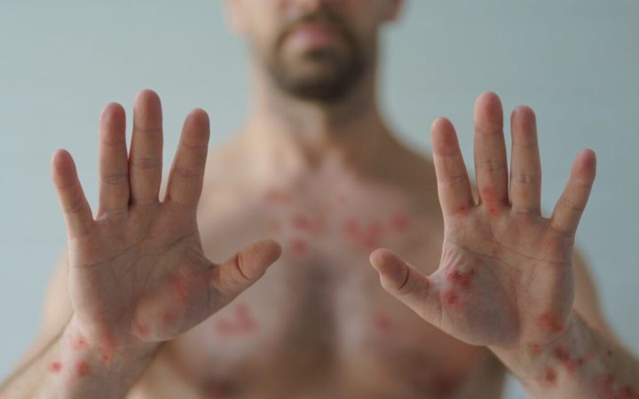 bărbat cu iritații ale pielii cauzate cauzate de variola maimuței (mpox)