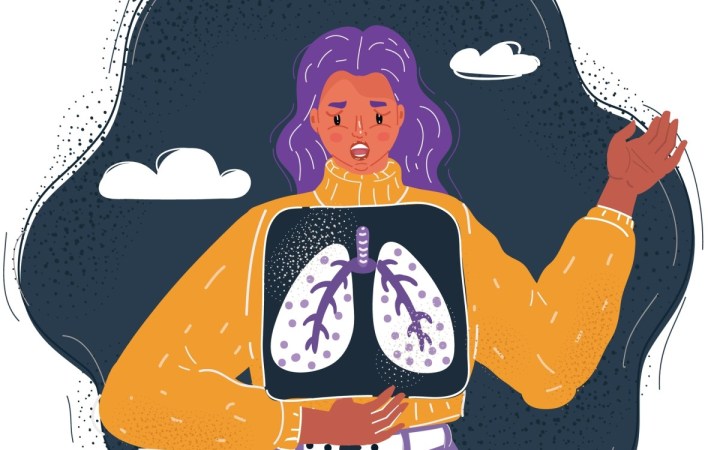 cancerul pulmonar la femei tinere nefumătoare. femeie cu radiografie pulmonară