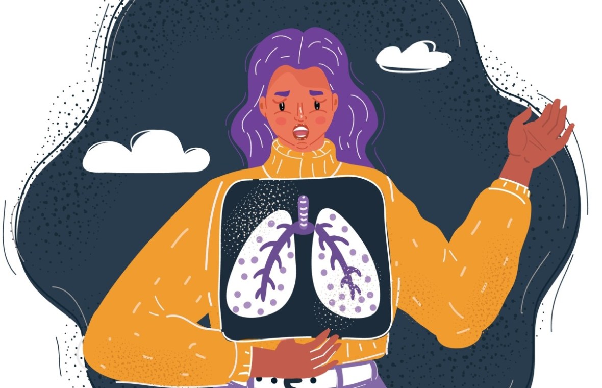 cancerul pulmonar la femei tinere nefumătoare. femeie cu radiografie pulmonară