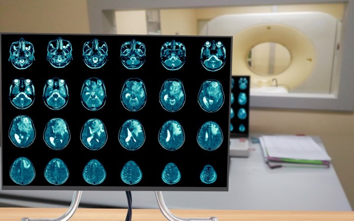 glioblastom. rezultate CT cerebral
