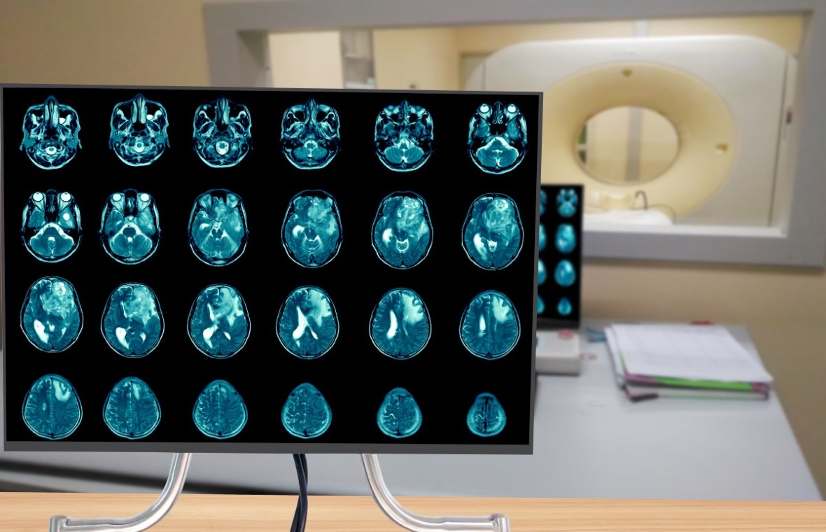 glioblastom. rezultate CT cerebral