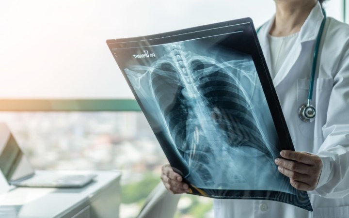 semnele cancerului pulmonar. medic care analizează o radiografie pulmonară