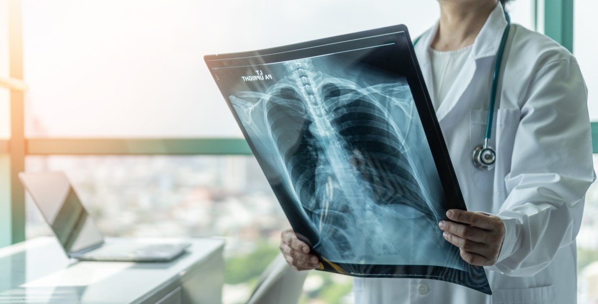 semnele cancerului pulmonar. medic care analizează o radiografie pulmonară