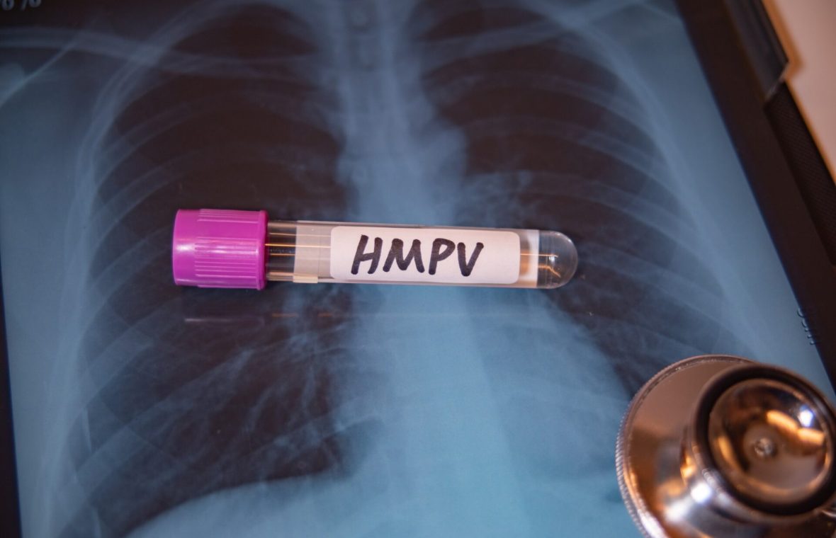 fiolă cu hmpv pe o radiografie pulmonară