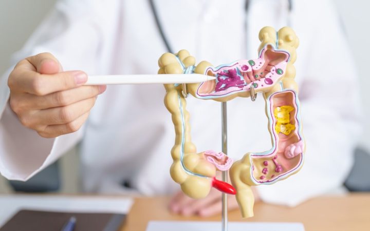 mulaj de intestin gros pe care medicul exemplifică cancerul colorectal
