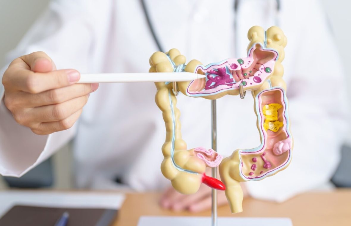 mulaj de intestin gros pe care medicul exemplifică cancerul colorectal