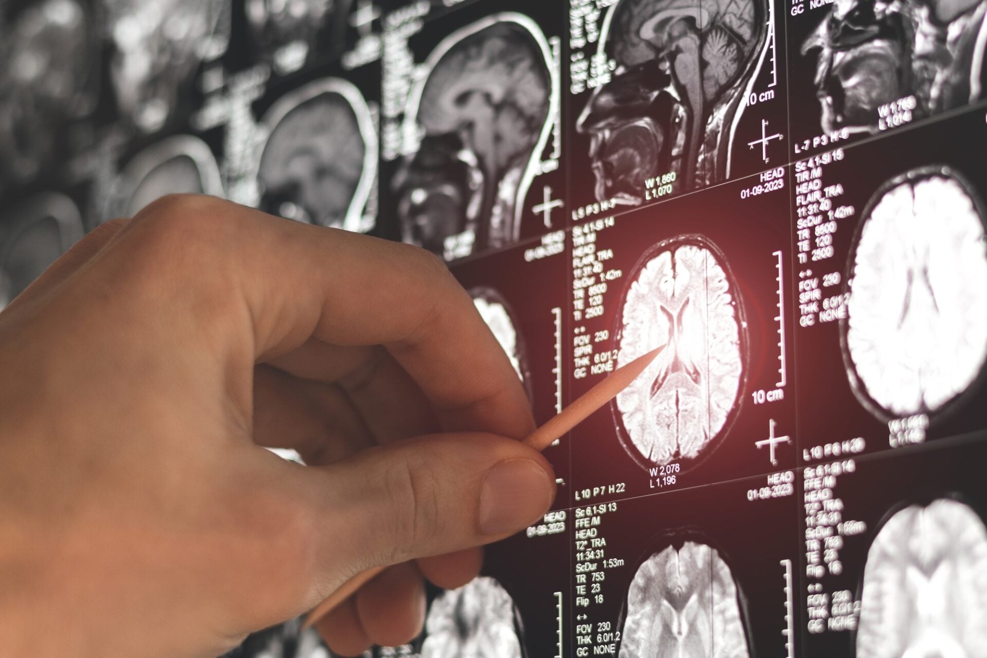 Ar fi trebuit să facă boala Alzheimer la 50 de ani, la fel ca 11 dintre rudele sale, dar meseria lui l-a protejat