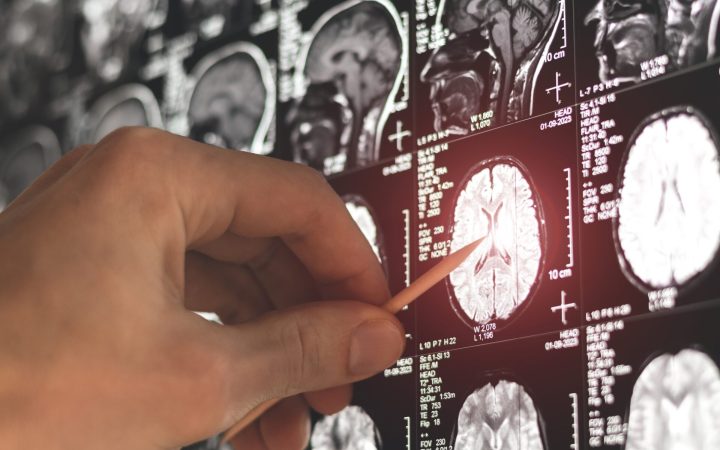 doctor se uită pe imaginile unui rmn cerebral