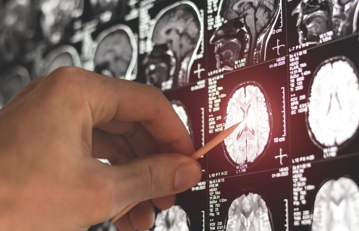 doctor se uită pe imaginile unui rmn cerebral